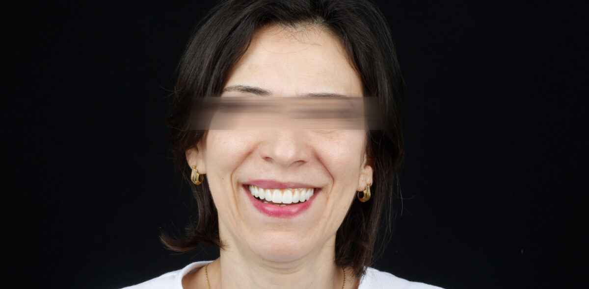 Après